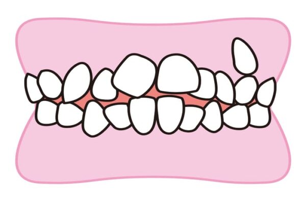 叢生（そうせい）の歯並びを示したイラスト