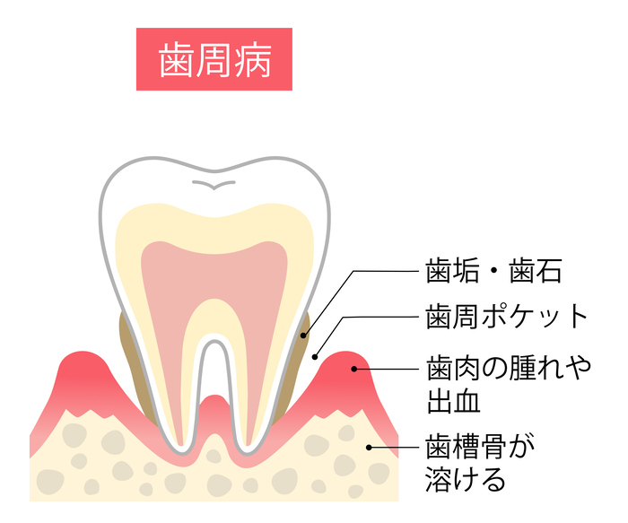 歯周病のしくみ　断面図
