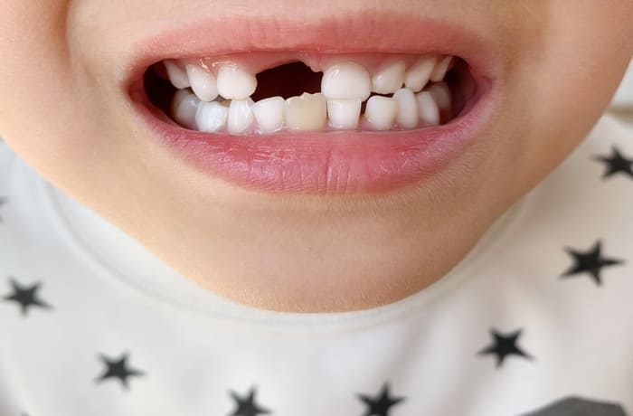 乳歯が抜けたあと永久歯がまだ生えていない子どもの口元