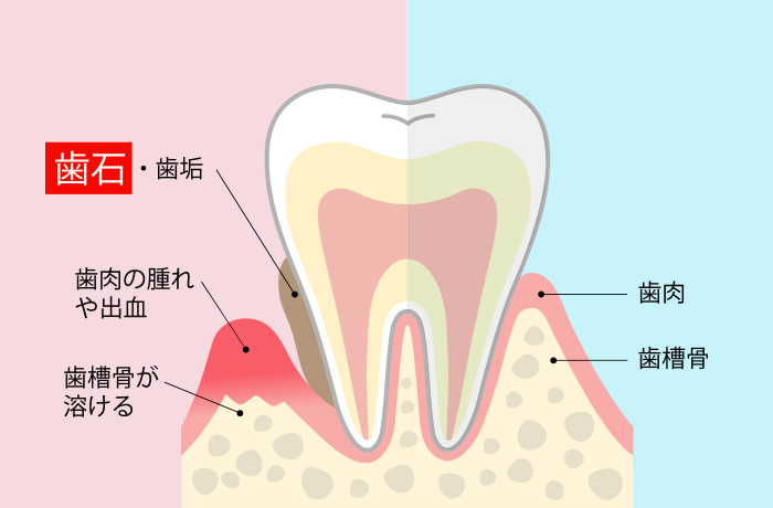 歯石は歯ブラシでは取り除けない