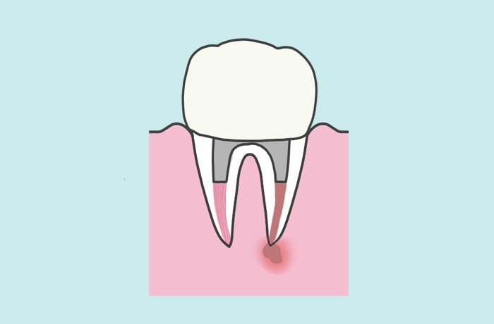歯の内部の炎症