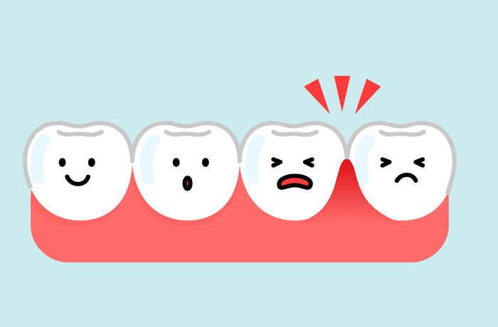 歯の周囲の炎症