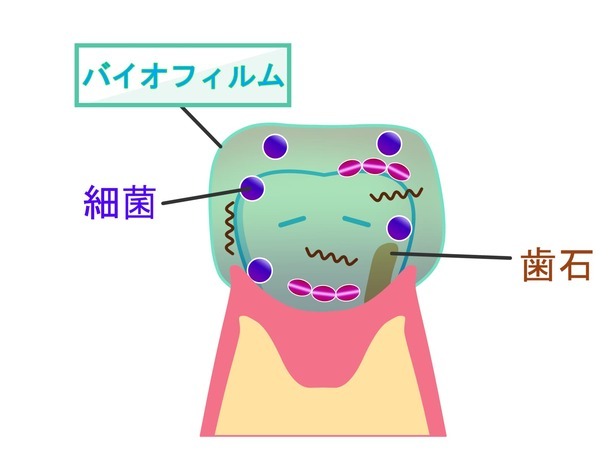 歯周病や虫歯の原因となるバイオフィルムと歯石の説明イラスト