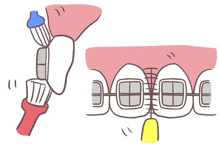 矯正器具のイラスト