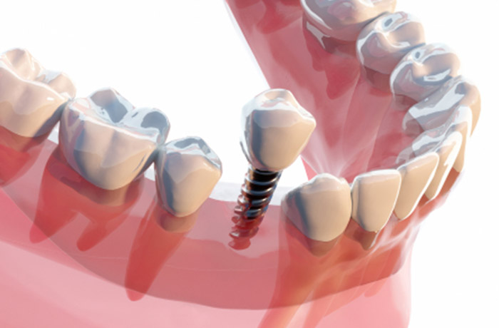 インプラントイメージ