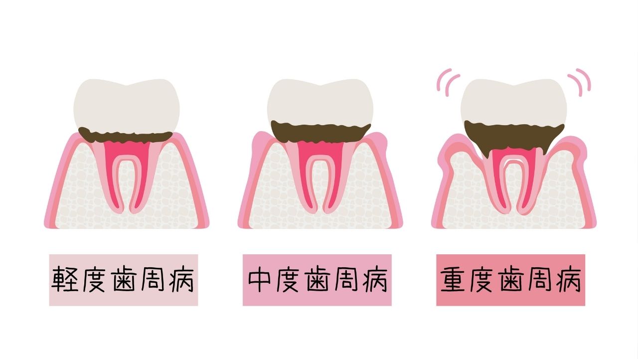 歯周病の進行イメージイラスト
