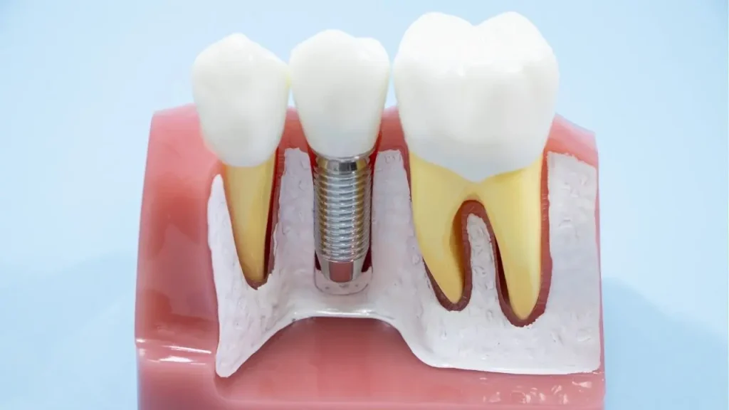インプラントの模型